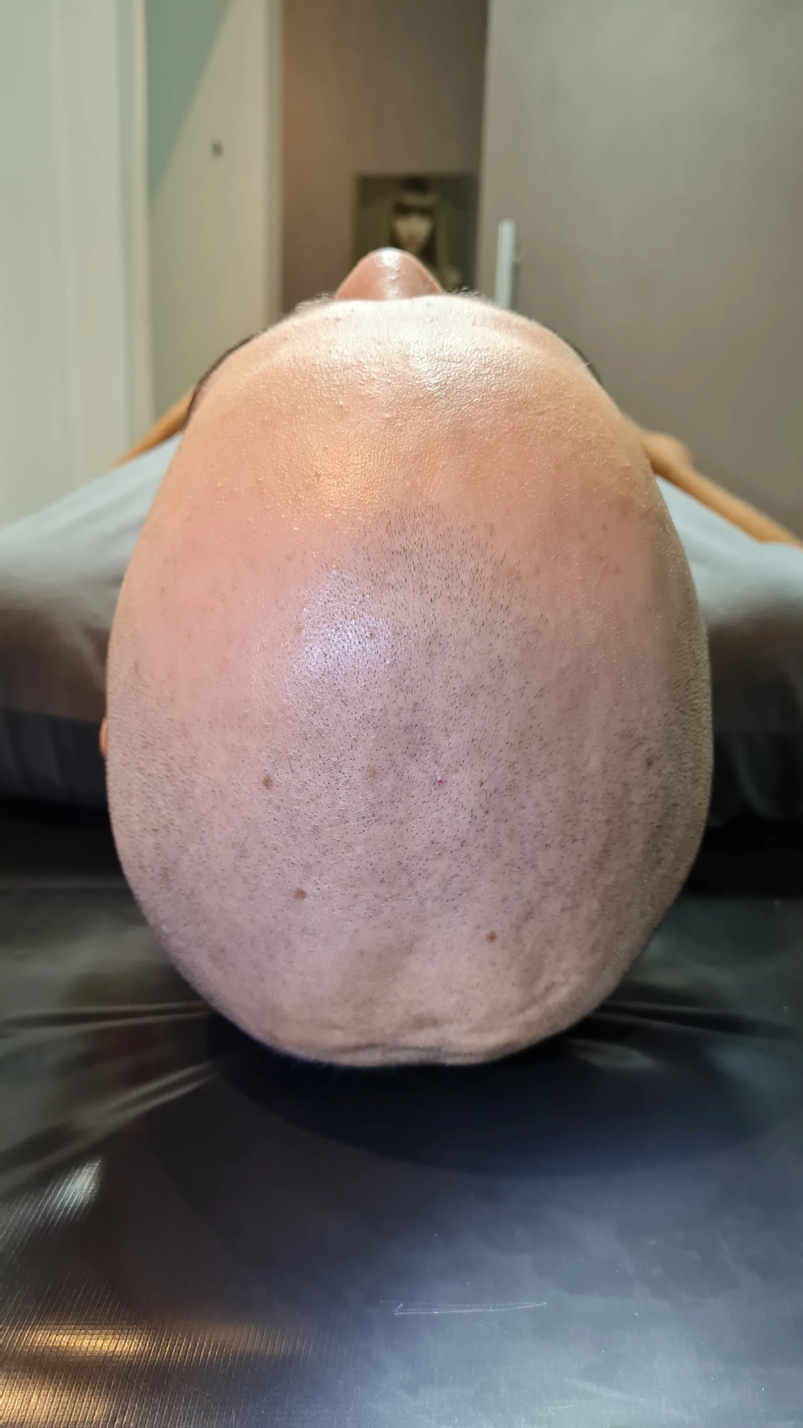 Micropigmentação capilar — resultado