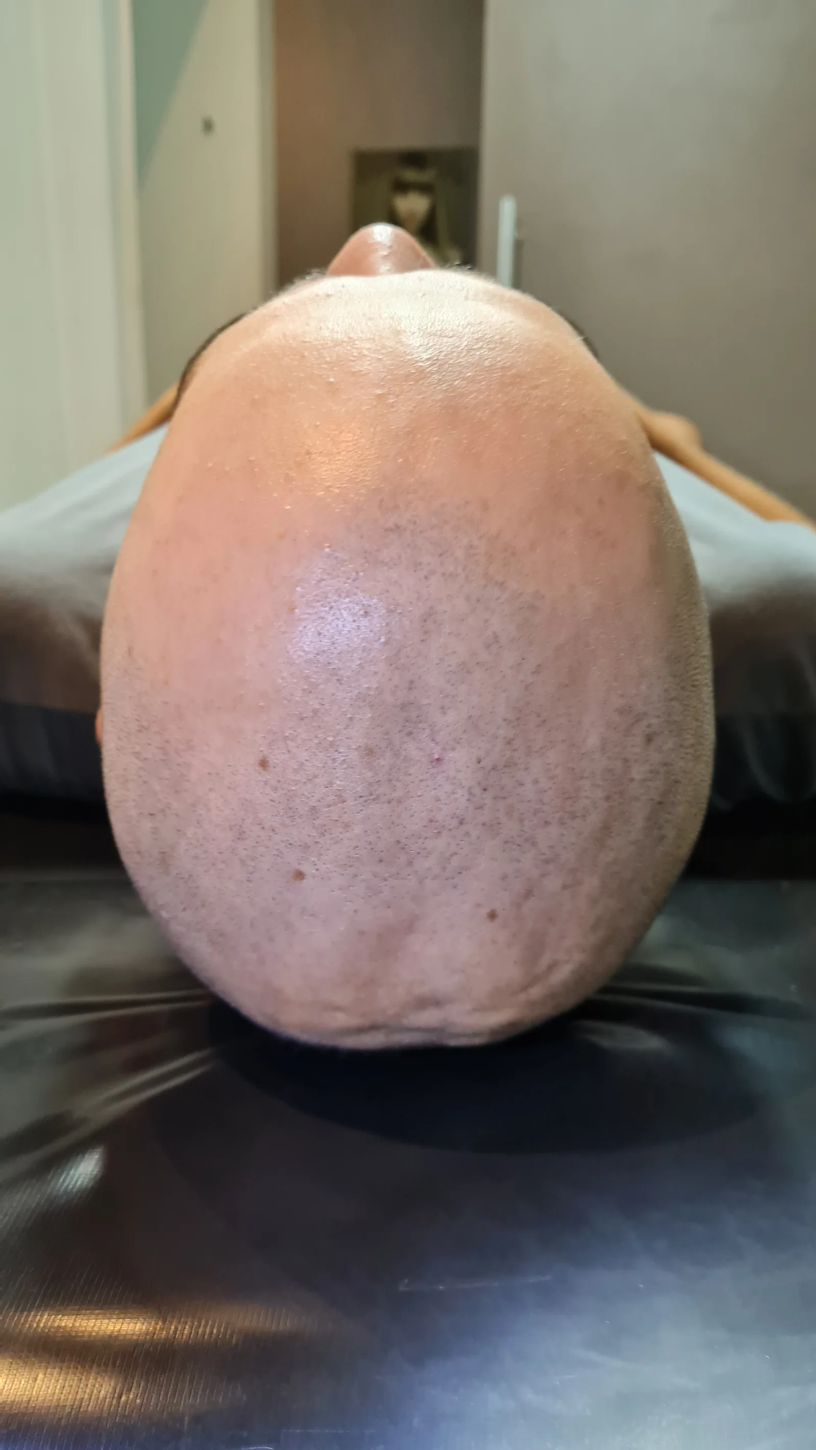 Micropigmentação capilar — resultado
